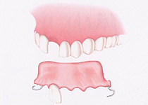 �A可撤性部分床義歯（バーシャルデンチャー）取り外し式の部分入れ歯